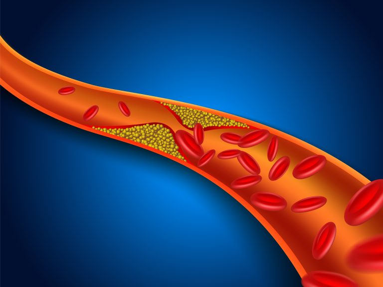 Foods to Avoid to Lower Cholesterol